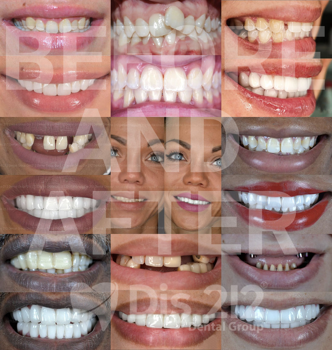 Dental Treatments Before and After Diş 212