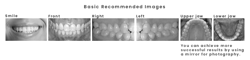 Имплантация зубов в Турции