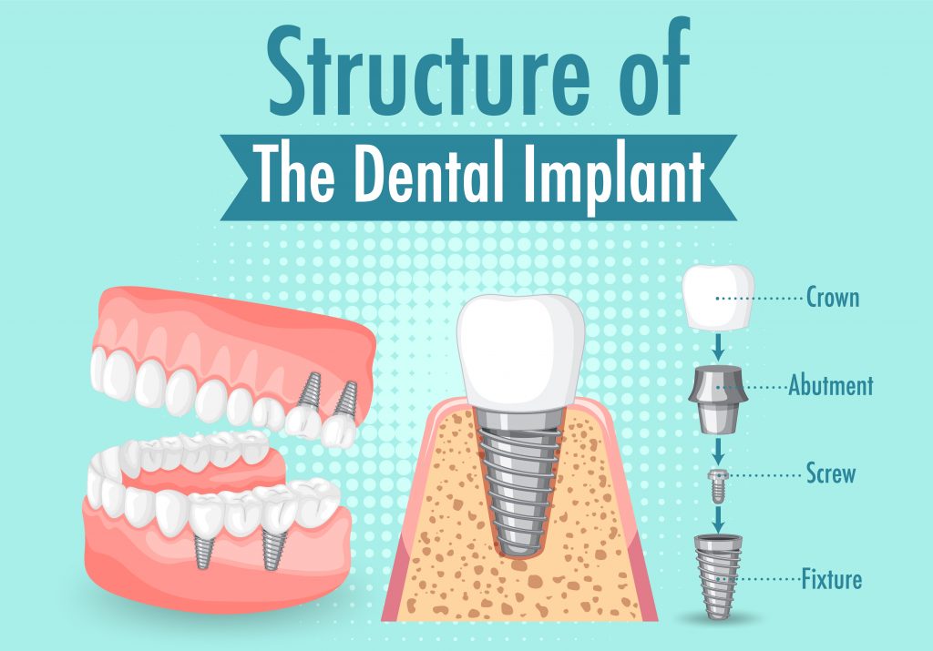 Full Mouth Dental Implants Turkey Package Deals 10 Полноротовые зубные имплантаты Турция Пакетные предложения