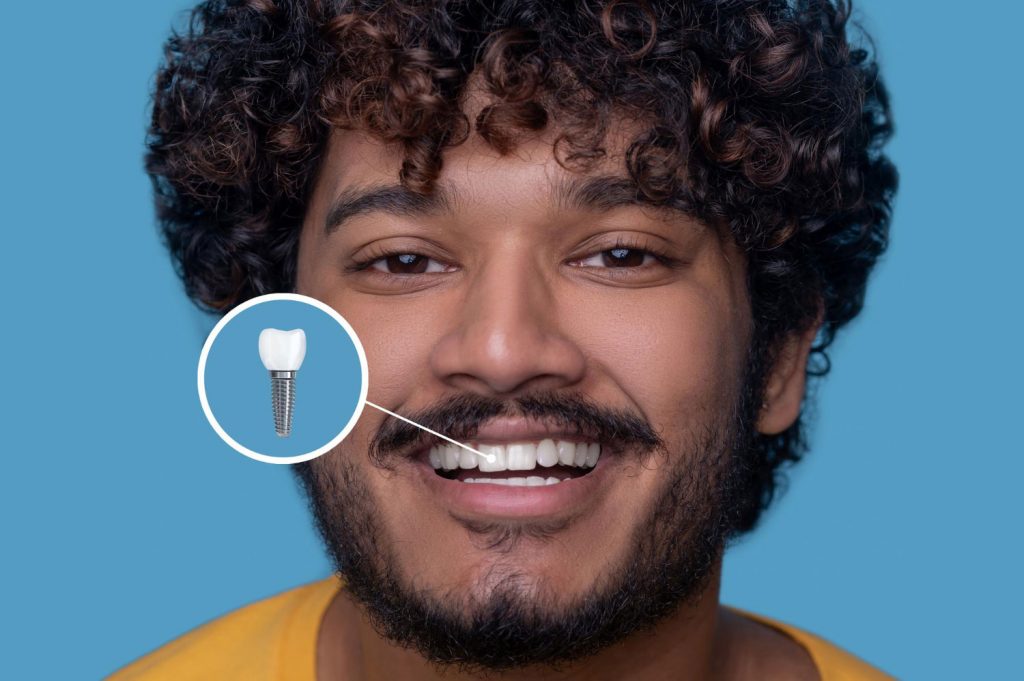 Full Mouth Dental Implants in Turkey Price: Affordable Solutions for a Complete Smile 5 Имплантация зубов во весь рот в Турции цена